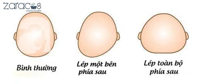 dau-hieu-tre-bi-dau-phang