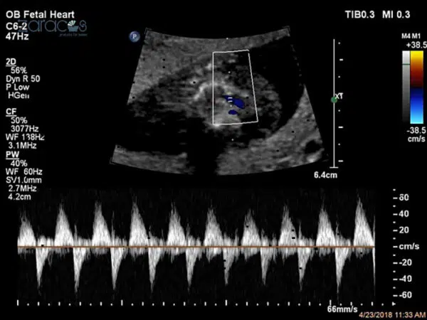 nhip-tim-thai-nhi-on-dinh-phat-trien-tot