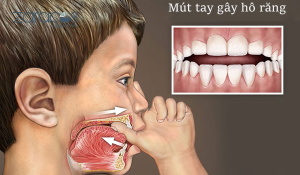 tre-mut-tay-co-the-bi-ho-rang