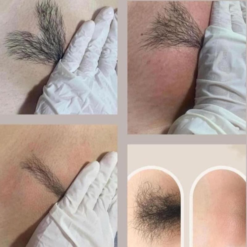 triet-long-bikini-tao-hinh-2