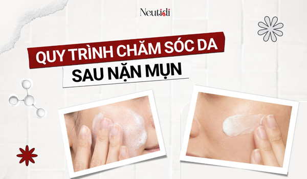 quy-trinh-cham-soc-da-sau-nan-mun-voi-Neutidi